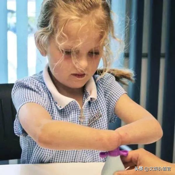 真实版“战斗天使”阿丽塔：13岁机械臂美少女，励志到哭！