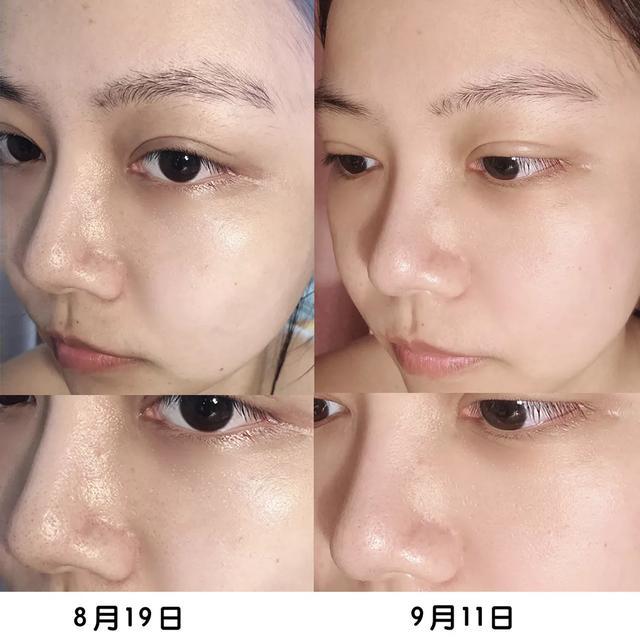 微整形美白针,微整形是永久的吗