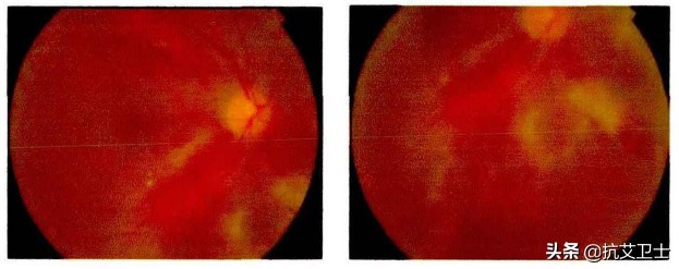 感染HIV后，这里感觉不如从前了