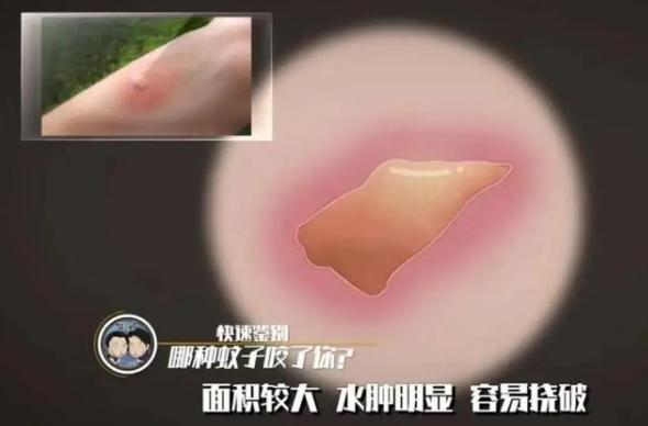 三种常见蚊子咬的包如何快速止痒消除，三种被叮的包要分清楚
