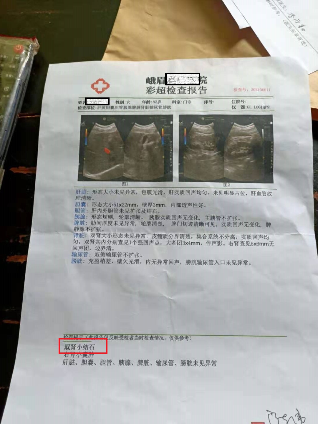 长期吃降压药会导致肾结石吗,降压药导致肾结石