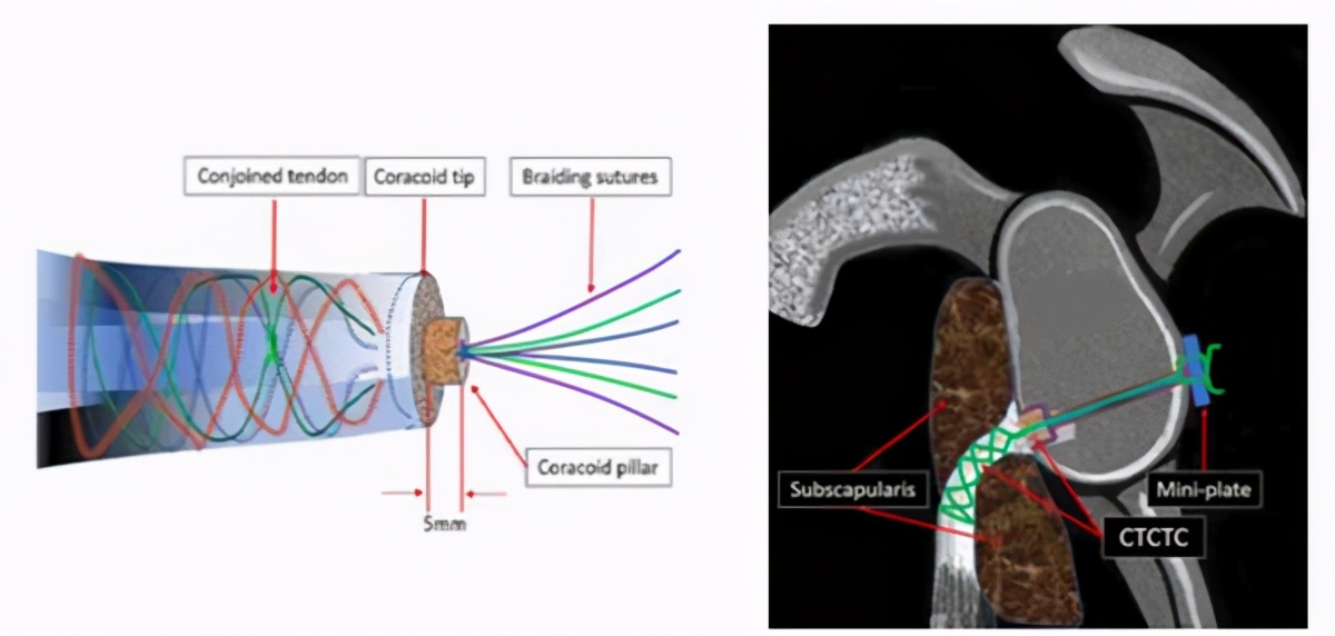 肩关节正斜位怎么治疗,怎么判断肩关节稳定不稳定