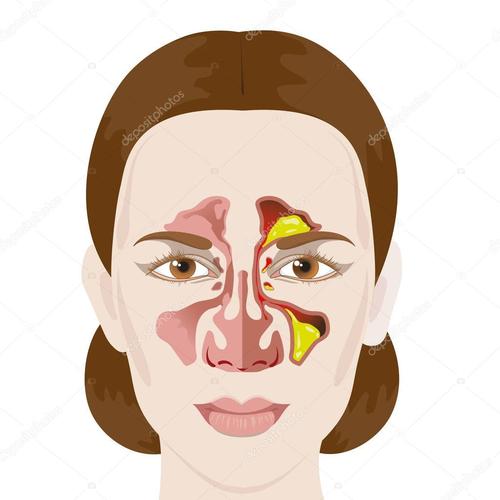 鼻内镜手术一般几天出院,鼻内镜术后病情观察啥