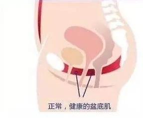 剖腹产盆底会松弛吗,剖腹产盆底肌会不会松