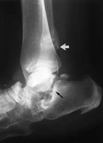 神经性骨关节病,神经性关节炎症状图片