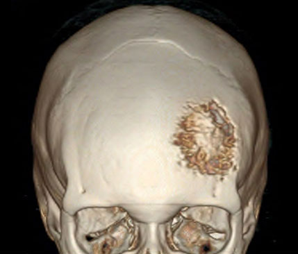 张医生大白话：一文读懂脑膜瘤