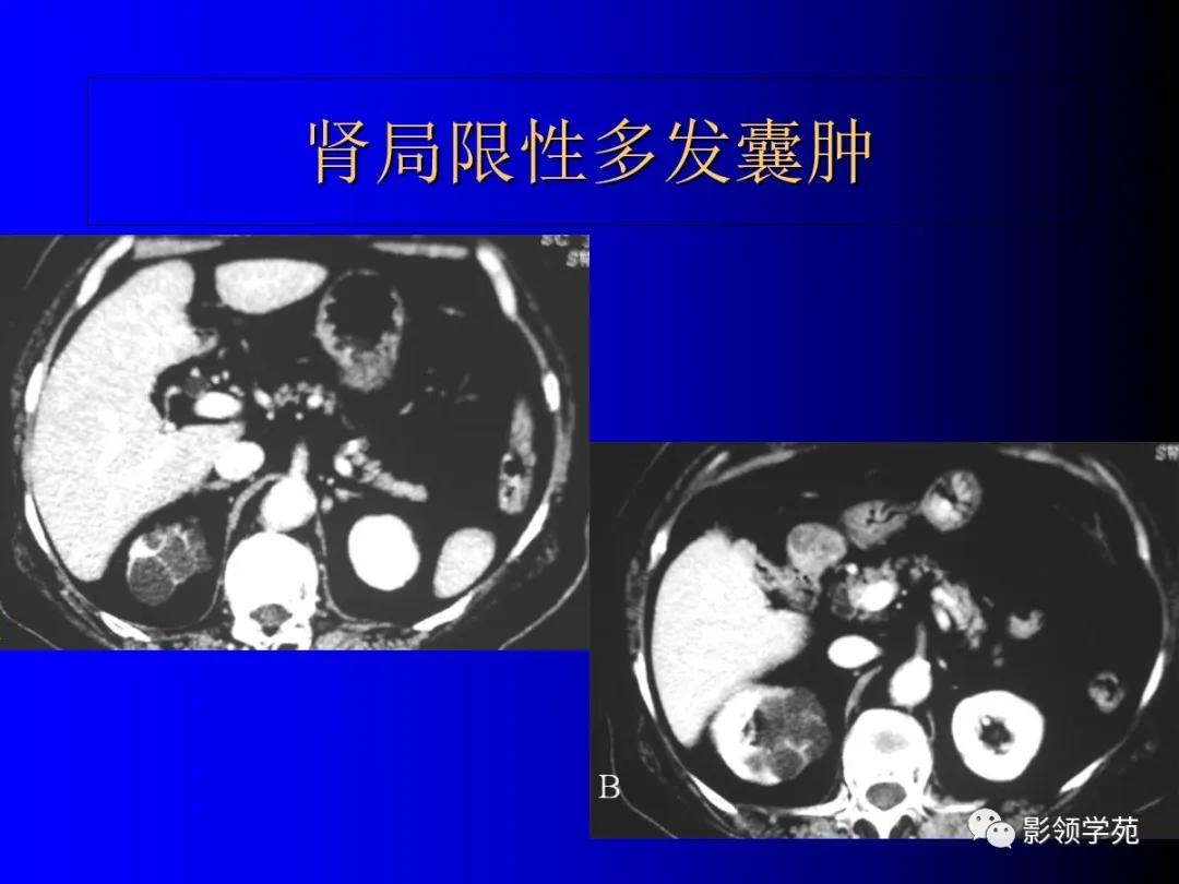 肾脏囊性肿块的影像学特点,肾脏典型病理图片及解析