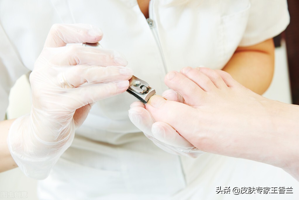 拔倒刺引起甲沟炎用什么药,甲沟炎不是嵌甲怎么办