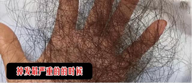 去头屑去螨虫哪个洗发水最有效,去头屑去螨虫用哪个洗发水最有效