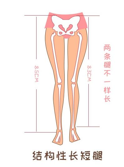 产后长短腿如何矫正,产后长短腿形成的原因和治疗方法