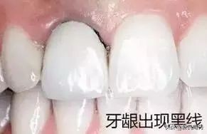 良医|明星们都在做烤瓷牙？但你最好别跟风