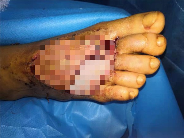 21岁女孩脚掌被截肢,女子脚掌被截肢