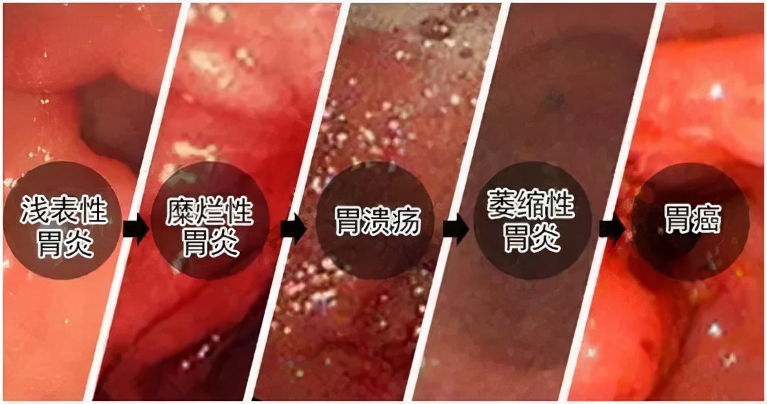 胃糜烂是怎么回事是胃烂了吗,胃糜烂一般超过几年容易癌变