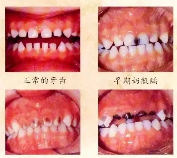 孩子门牙有点黑色是什么原因,儿童门牙发黑是什么原因引起的