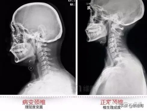 神经根型颈椎病，仅1%的患者需要手术，确定不是你？