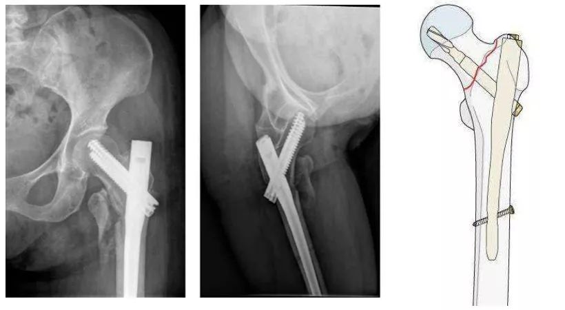 髋部骨折对老年人来说意味着什么,老人髋部骨折多长时间恢复到正常