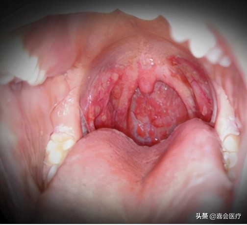 手足口病你必须知道,手足口病最新版知识解读
