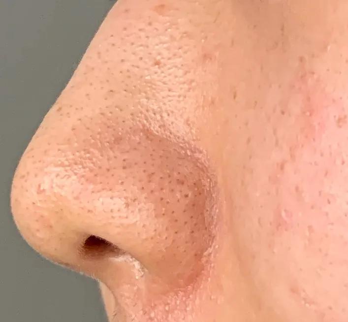 每到换季就会爆痘,换季时爆痘