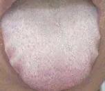 中医祛寒湿最好的方法,中医寒湿阻络怎么治疗