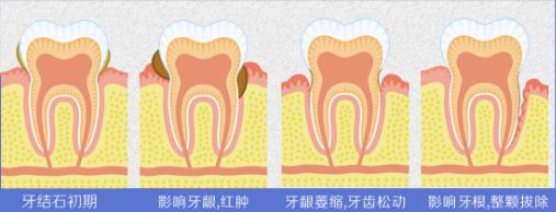 牙疼去医院一般怎么治疗,牙疼到半边脸痛去医院花多少钱