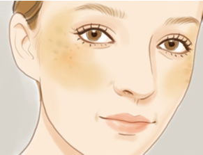 褐斑处理比较快,褐斑怎么去除呢