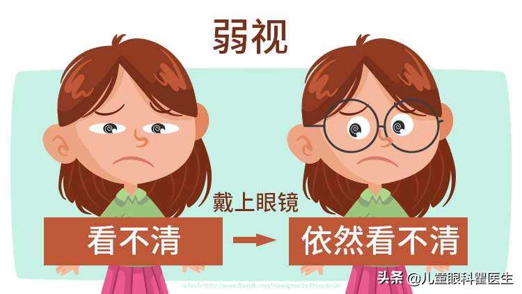 儿童弱视恢复最简单方法,儿童弱视最快的恢复方法