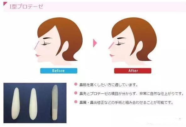 韩国与日本整容哪家强,日本整容vs韩国整容