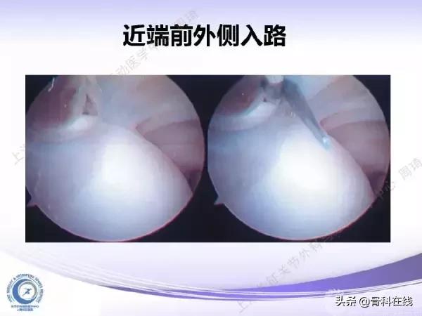 肘关节镜手术后引流,肘关节镜微创手术