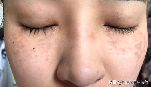 中药点斑好还是激光祛斑好,脸上有斑打激光过后吃有讲究吗