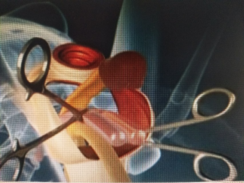 勃起功能障碍的治疗我们了解了，那么如何治疗阴茎异常勃起呢？