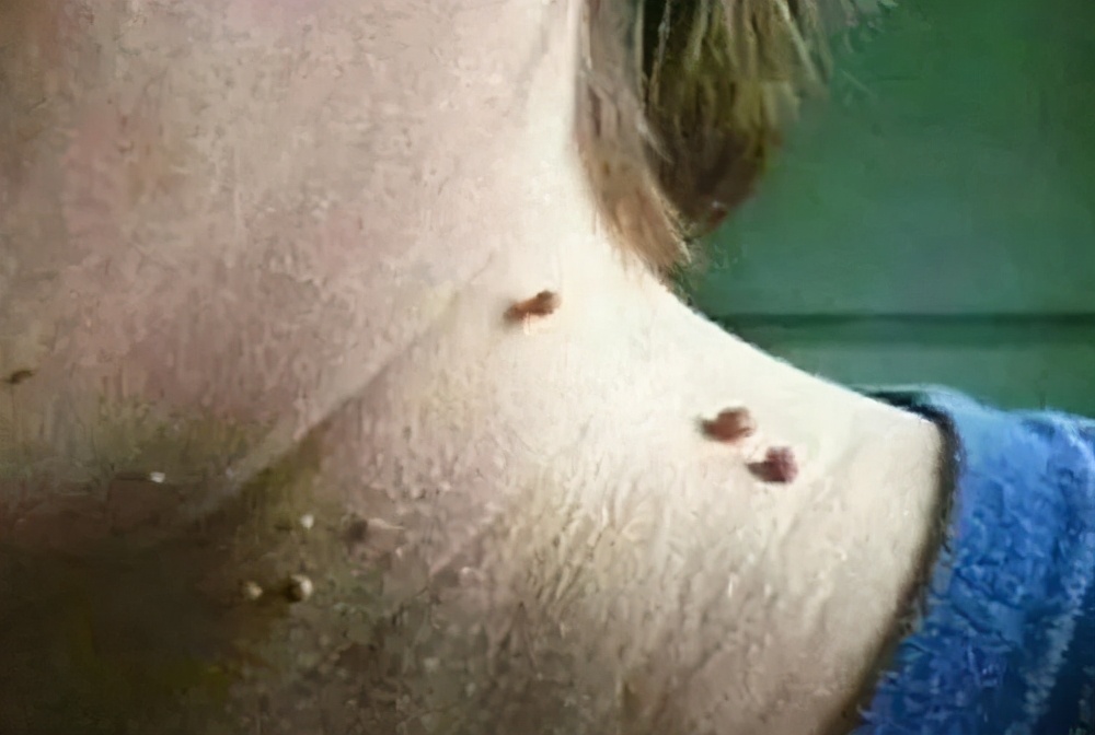 身上长了很多小肉疙瘩是怎么治,身上长肉疙瘩怎么办快速消除