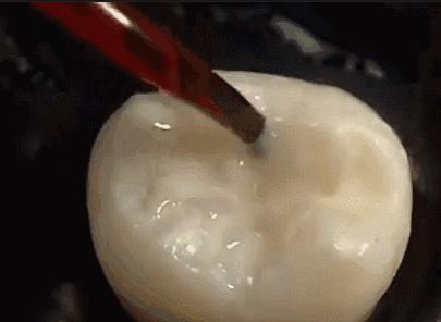 儿童窝沟封闭和龋齿填充,幼儿牙齿窝沟填充有必要吗