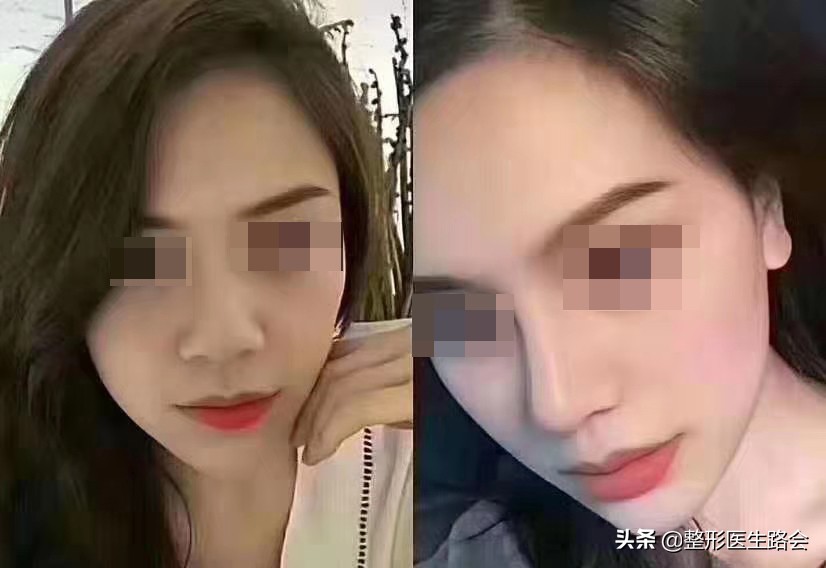鼻翼缩小会有什么影响,鼻翼缩小会不会影响鼻子呼吸