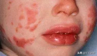 儿科常见出疹性疾病,儿科常见出疹性疾病有哪些