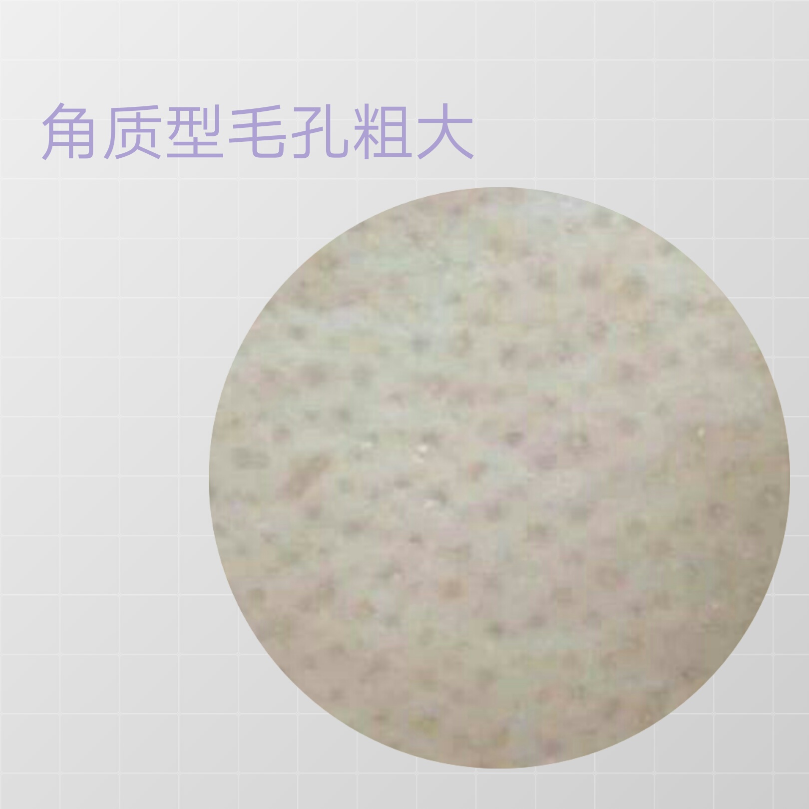 毛孔粗大怎么办给你最全护理指南,目前解决毛孔粗大最有效的手段