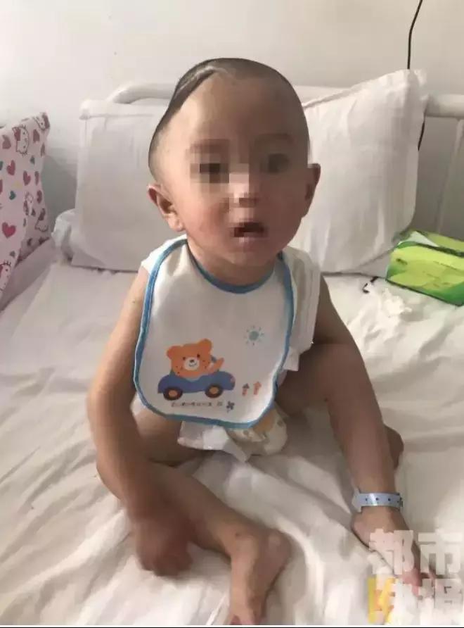 1岁宝宝脑出血,宝宝摔下床有脑出血怎么办