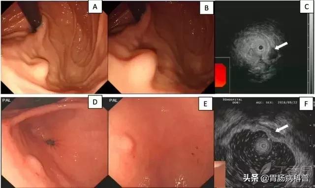 胃癌手术后一年胃镜说胃粘膜隆起,胃镜报告有隆起