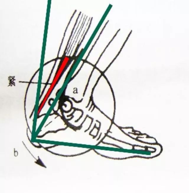 运动医学分析运动损伤案例,运动医学跟腱撕裂