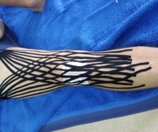 肌内效贴布的应用和原理 (髂胫束综合征怎么使用肌效贴)