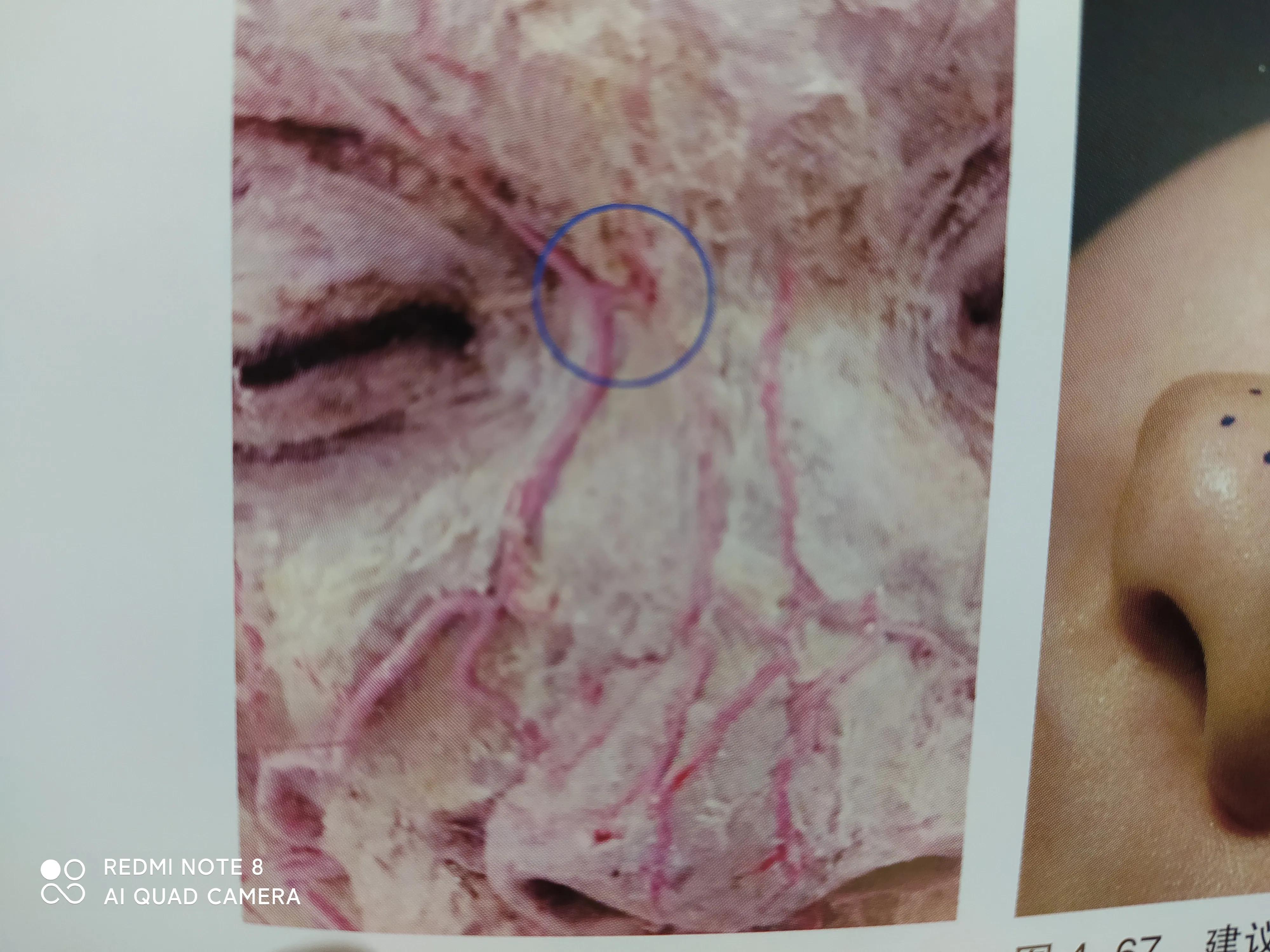 玻尿酸栓塞是打玻尿酸的位置吗,玻尿酸打鼻子栓塞好的过程