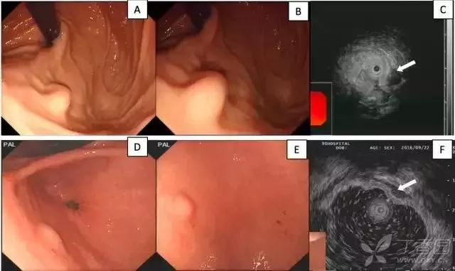 胃镜胃粘膜下隆起严重吗,胃镜提示粘膜下隆起病变
