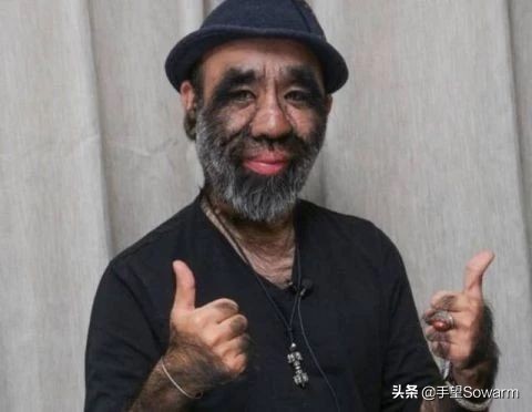 全世界体毛最多的人，是如何在歧视中逆袭为实力派歌手的？