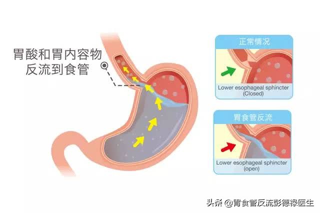 为什么胃炎不能彻底治愈,多年的胃炎怎么治