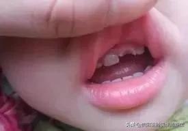 12岁前必须解决的错颌畸形,孩子十二岁牙畸形怎么办