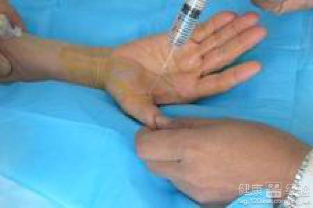 扳机指如何治疗,扳机指要怎么治疗