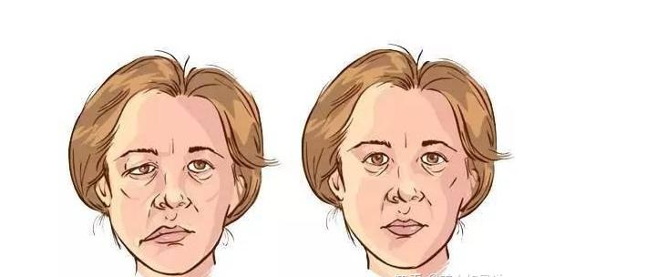 如何保持面瘫脸,面瘫脸怎么保护