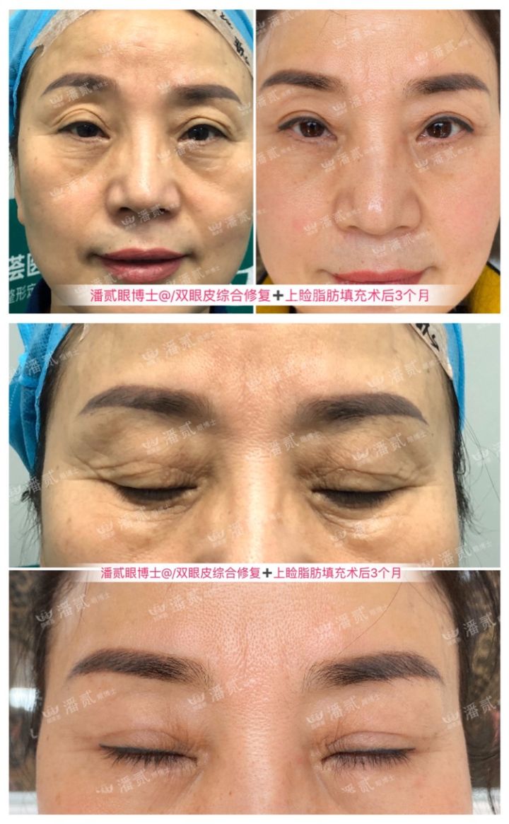 割了开扇双眼皮眼尾上扬太宽,眼尾上扬的眼睛适合什么双眼皮