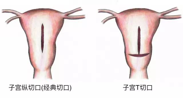 剖腹产后能不能顺产了,产妇要求剖腹产医生会建议顺产吗