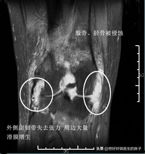 膝盖积水以后是热敷还是冷敷？真能解决问题吗？医生：可能都没用