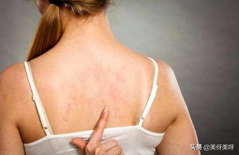 背后长痘痘怎么办最快最有效,背后长痘痘的原因和解决办法